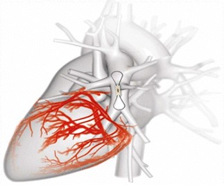 CardioMEMS™ Heart Failure System Education Banner